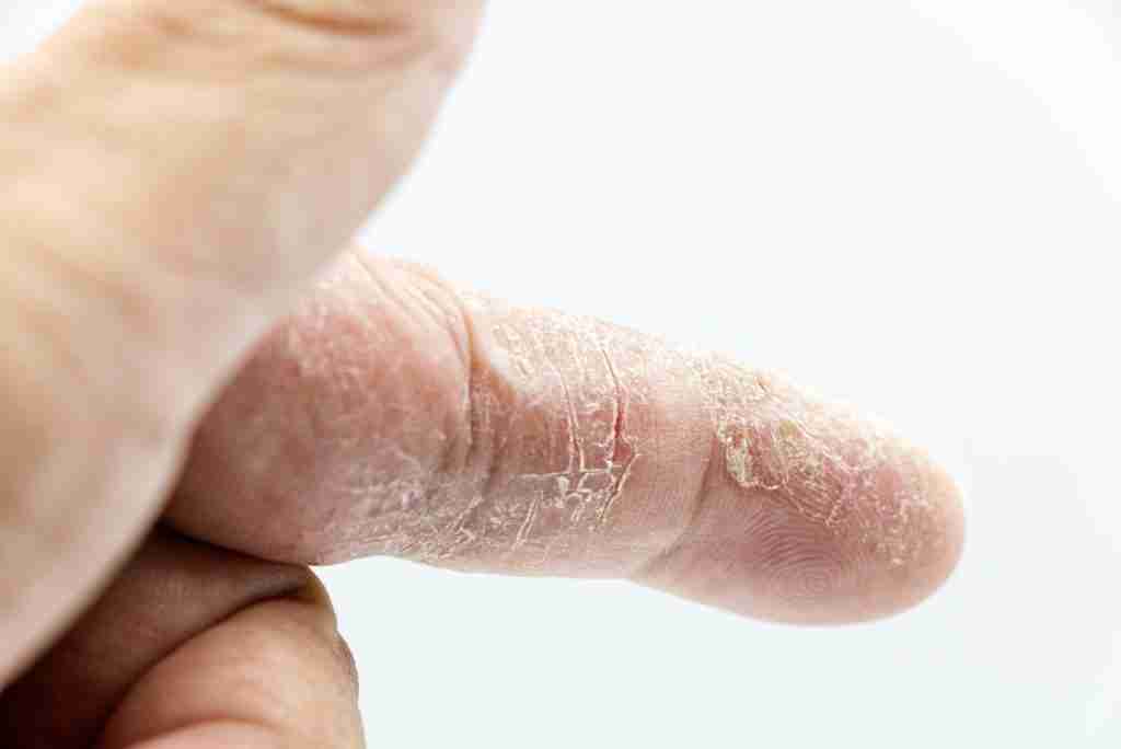 70 Creepy Facts That Will Keep You Up at Night 8 Close-up of Dry Skin on a Finger