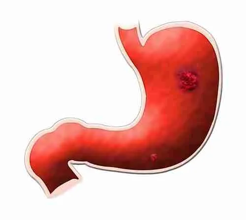 33 Fun Facts About Stomach | Digestive Powerhouse 3 stomach ulcer